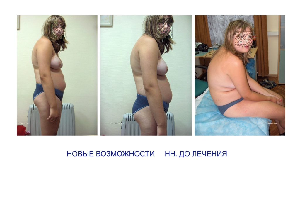 Сколиоз 4 степени где делают операции